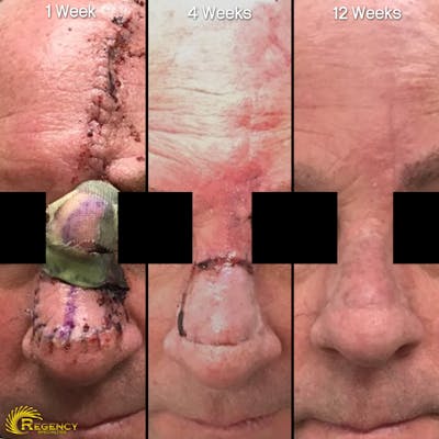 Facial and MOHS Reconstruction Before & After Gallery - Patient 6610928 - Image 1