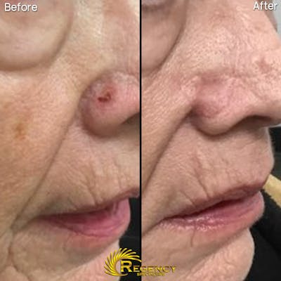Facial and MOHS Reconstruction Before & After Gallery - Patient 6610931 - Image 1