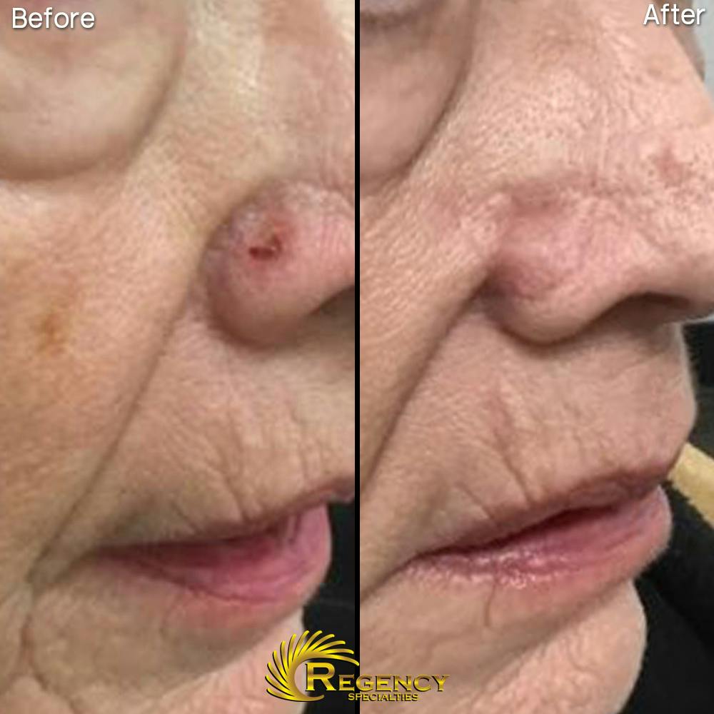 Facial and MOHS Reconstruction Before & After Gallery - Patient 6610931 - Image 1