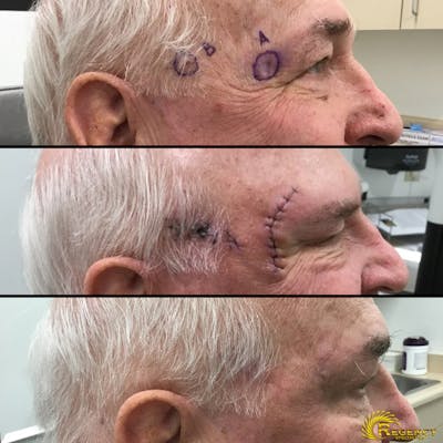 Facial and MOHS Reconstruction Before & After Gallery - Patient 6610932 - Image 1