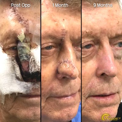 Facial and MOHS Reconstruction Before & After Gallery - Patient 6610933 - Image 1