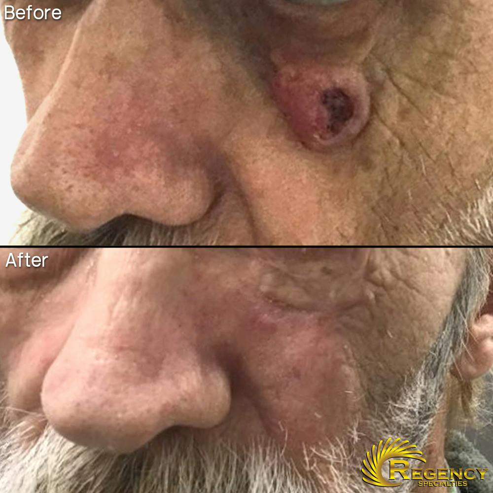 Facial and MOHS Reconstruction Before & After Gallery - Patient 6610934 - Image 1