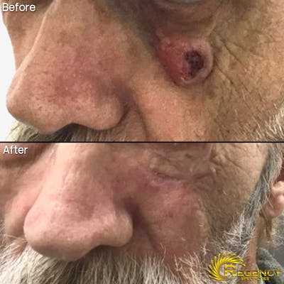 Facial and MOHS Reconstruction Before & After Gallery - Patient 6610934 - Image 1