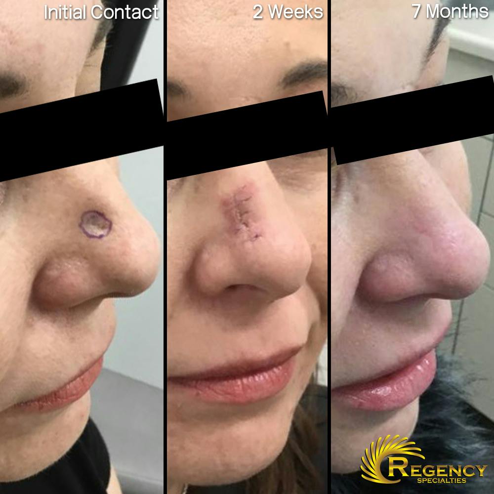 Facial and MOHS Reconstruction Before & After Gallery - Patient 6610935 - Image 1