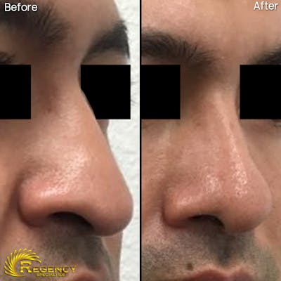Rhinoplasty Before & After Gallery - Patient 6610968 - Image 1