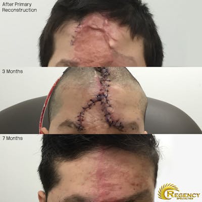 Skull Reconstruction & Cranioplasty Before & After Gallery - Patient 6610969 - Image 1