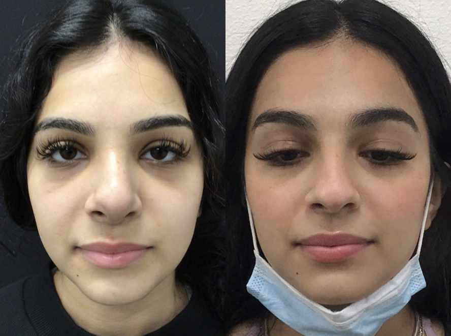 Rhinoplasty