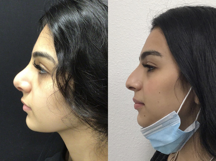 Rhinoplasty