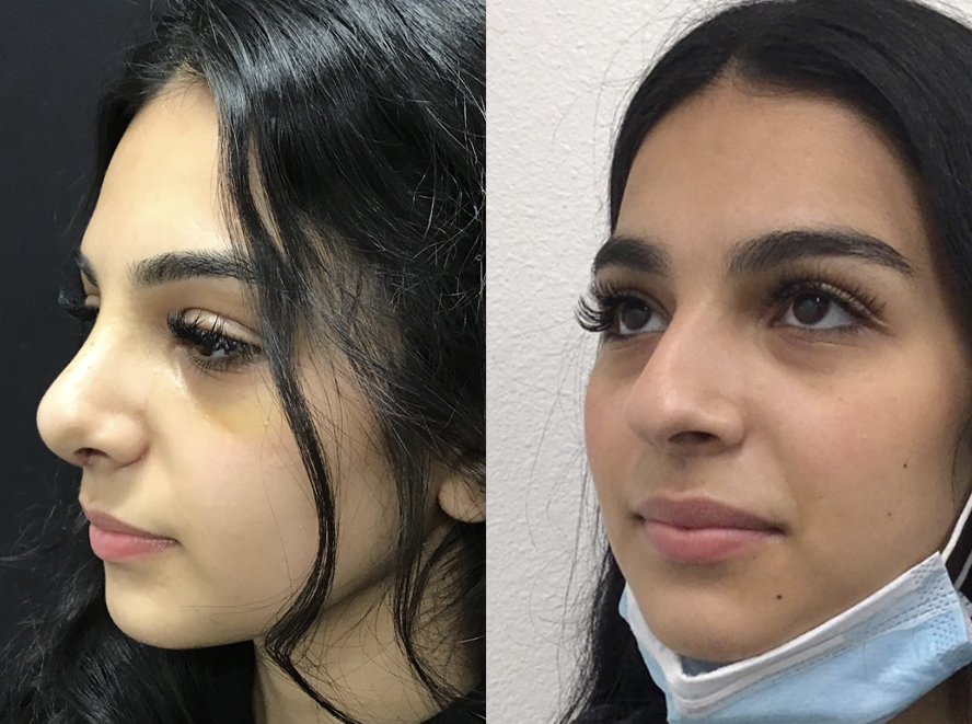 Rhinoplasty