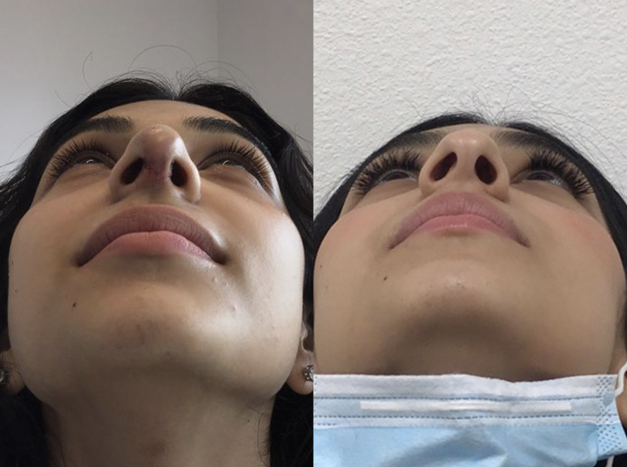 Rhinoplasty