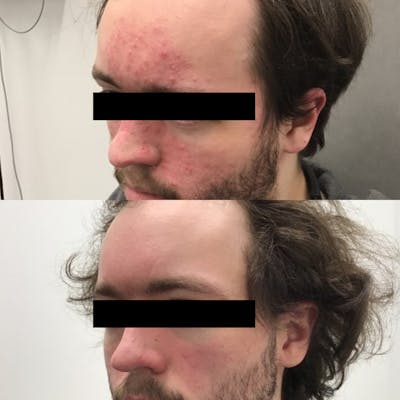 Acne Treatment Before & After Gallery - Patient 64221501 - Image 1