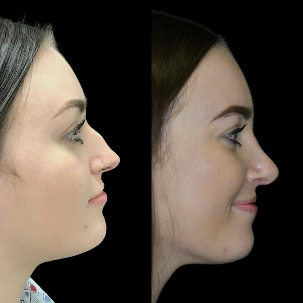 Rhinoplasty Before & After Gallery - Patient 64221520 - Image 1