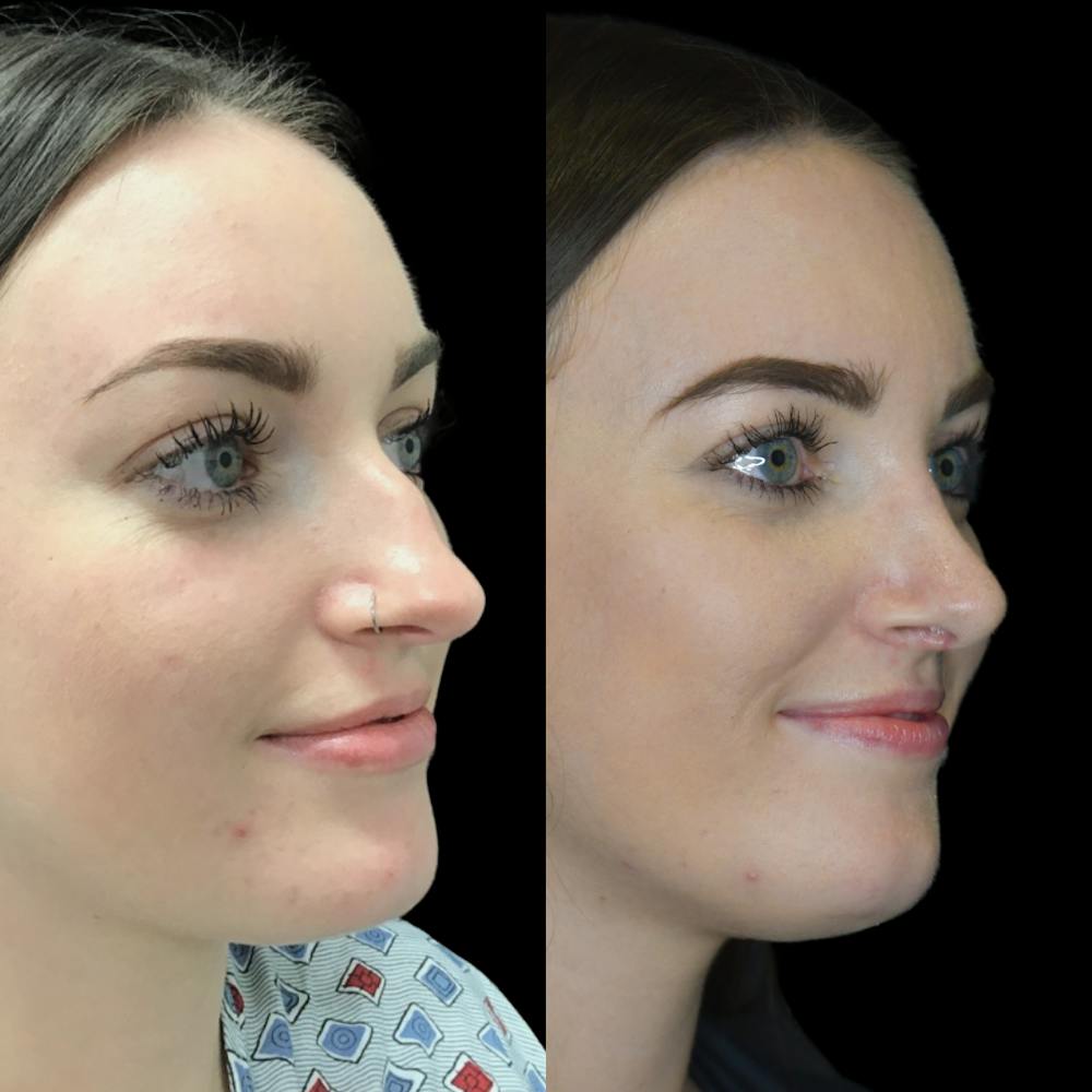 Rhinoplasty Before & After Gallery - Patient 64221520 - Image 2