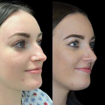 Rhinoplasty Before & After Gallery - Patient 64221520 - Image 2