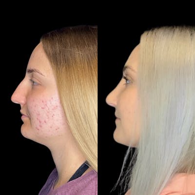 Rhinoplasty Before & After Gallery - Patient 64221521 - Image 1