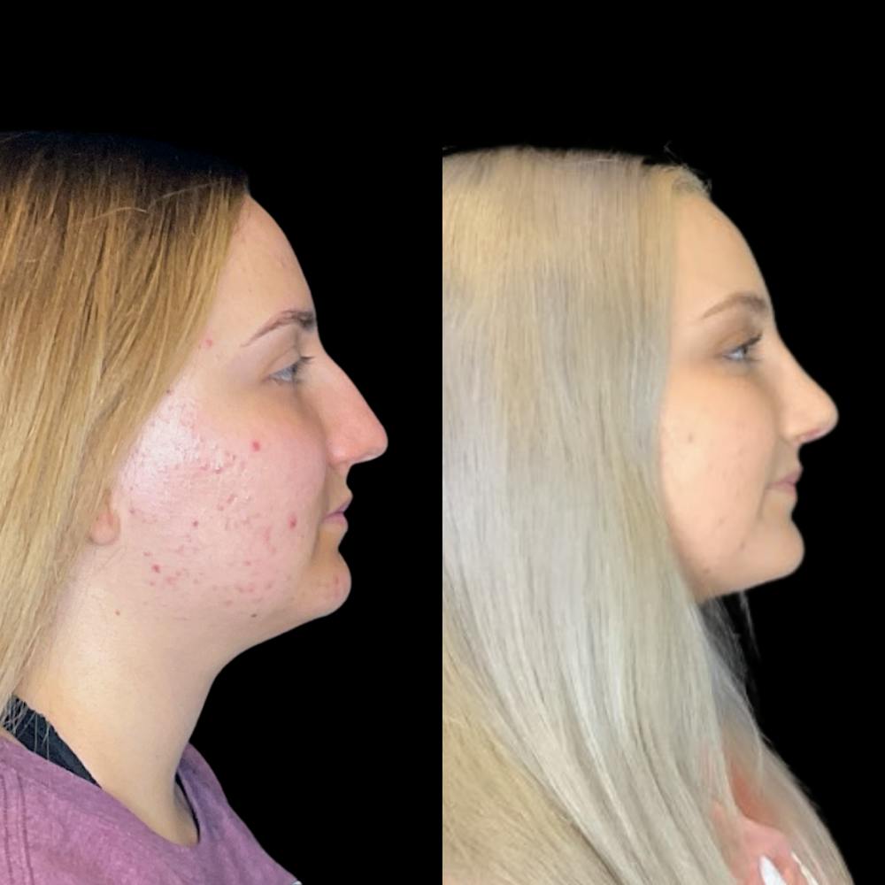 Rhinoplasty Before & After Gallery - Patient 64221521 - Image 2