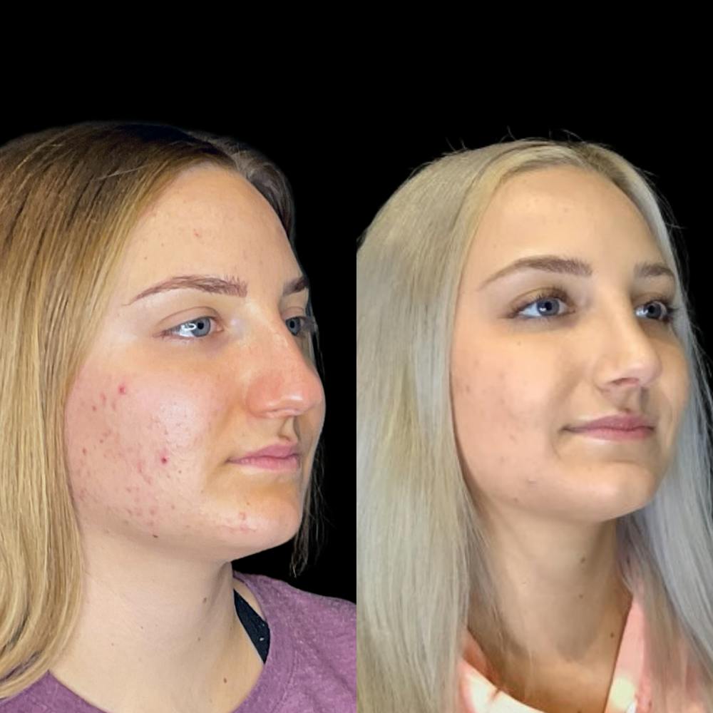 Rhinoplasty Before & After Gallery - Patient 64221521 - Image 3