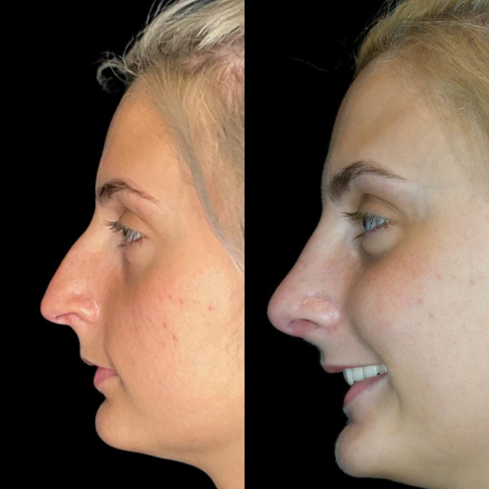 Rhinoplasty Before & After Gallery - Patient 64221522 - Image 1