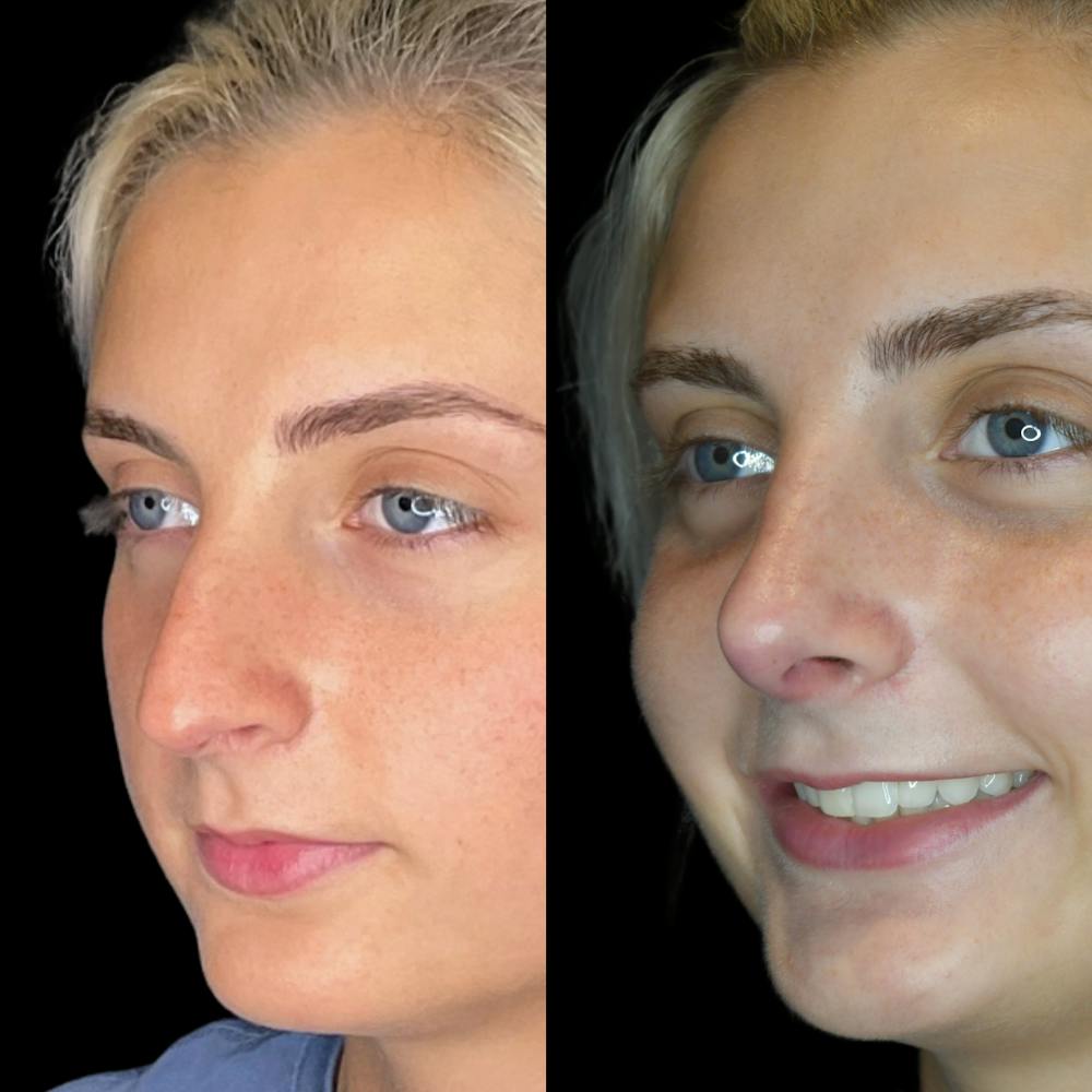 Rhinoplasty Before & After Gallery - Patient 64221522 - Image 2