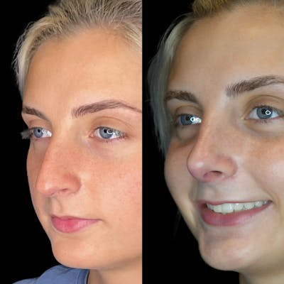 Rhinoplasty Before & After Gallery - Patient 64221522 - Image 2