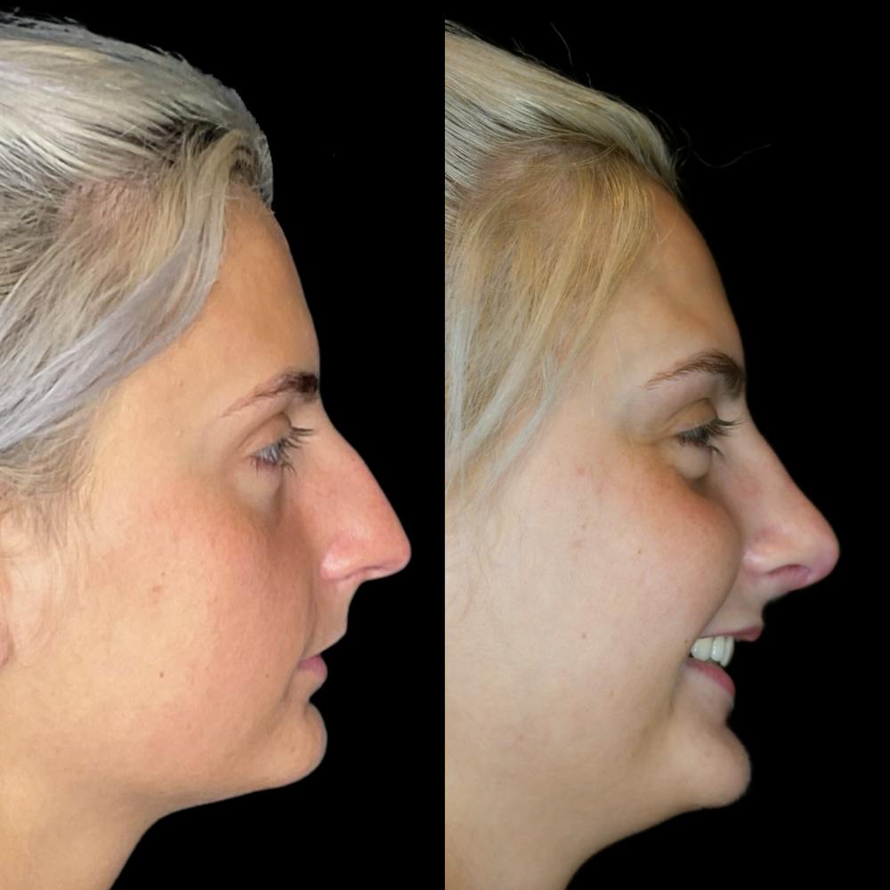 Rhinoplasty Before & After Gallery - Patient 64221522 - Image 3