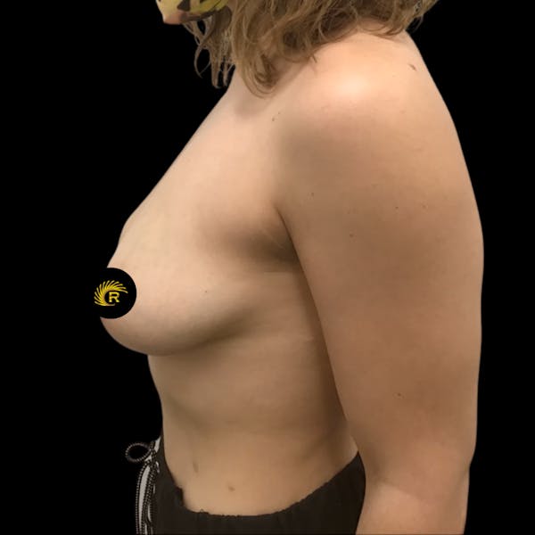 Breast Reconstruction Before & After Gallery - Patient 69402794 - Image 3