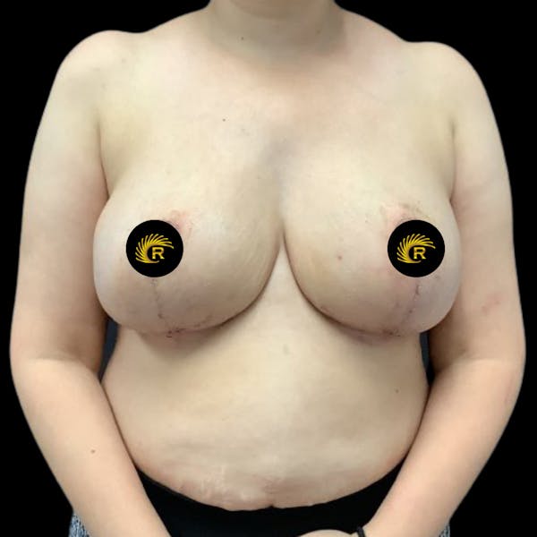 Breast Reconstruction Before & After Gallery - Patient 69402795 - Image 2