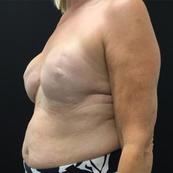 Breast Reconstruction Before & After Gallery - Patient 69402796 - Image 3
