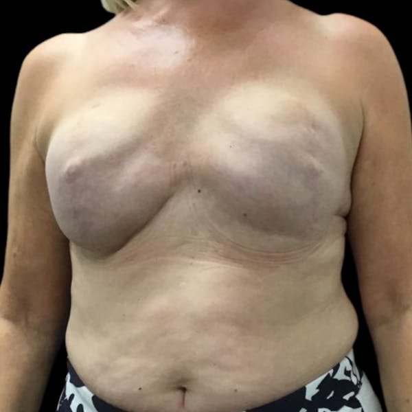 Breast Reconstruction Before & After Gallery - Patient 69402796 - Image 1
