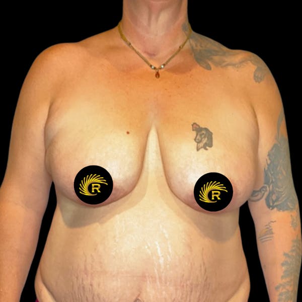 Breast Reduction Before & After Gallery - Patient 69402809 - Image 1