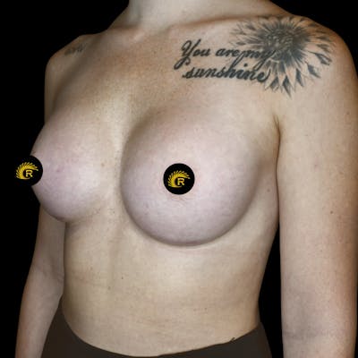 Breast Augmentation Before & After Gallery - Patient 121820040 - Image 4