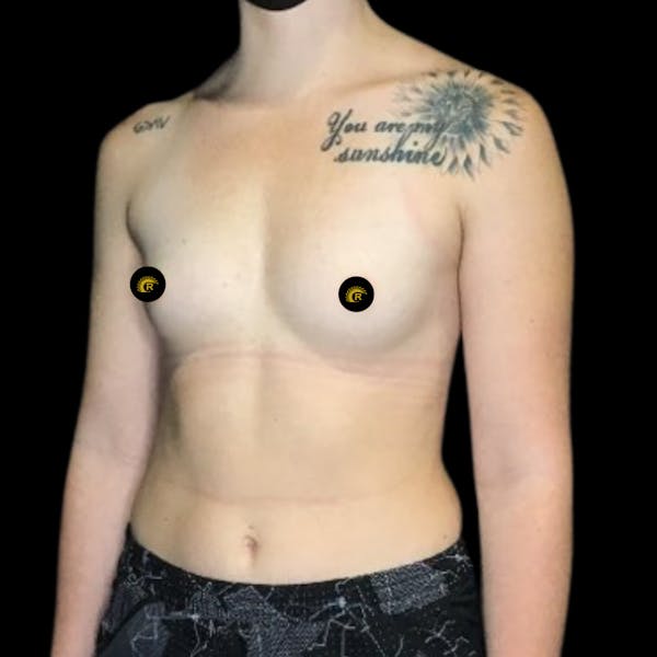 Breast Augmentation Before & After Gallery - Patient 121820040 - Image 3