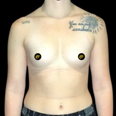 Breast Augmentation Before & After Gallery - Patient 121820040 - Image 1