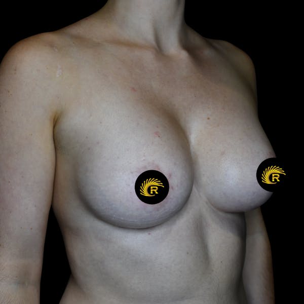 Breast Augmentation Before & After Gallery - Patient 121820041 - Image 4
