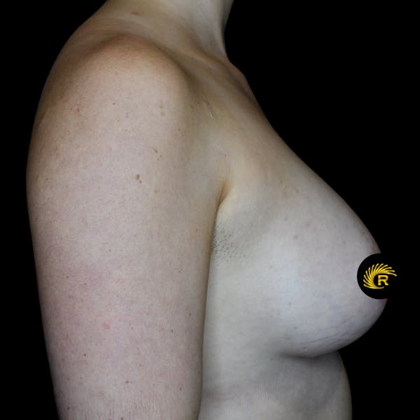 Breast Augmentation Before & After Gallery - Patient 121820041 - Image 6