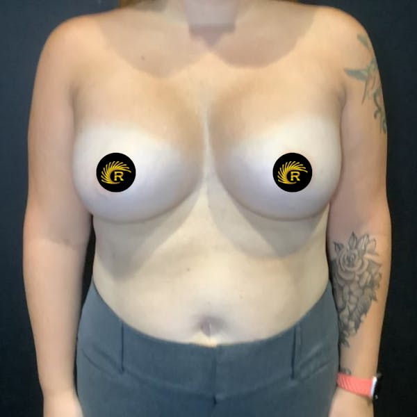Breast Augmentation Before & After Gallery - Patient 121820045 - Image 2
