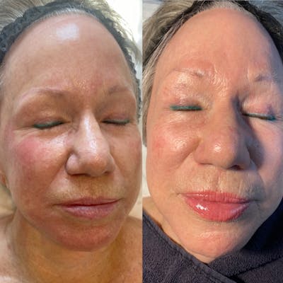 Microneedling Before & After Gallery - Patient 71703193 - Image 1