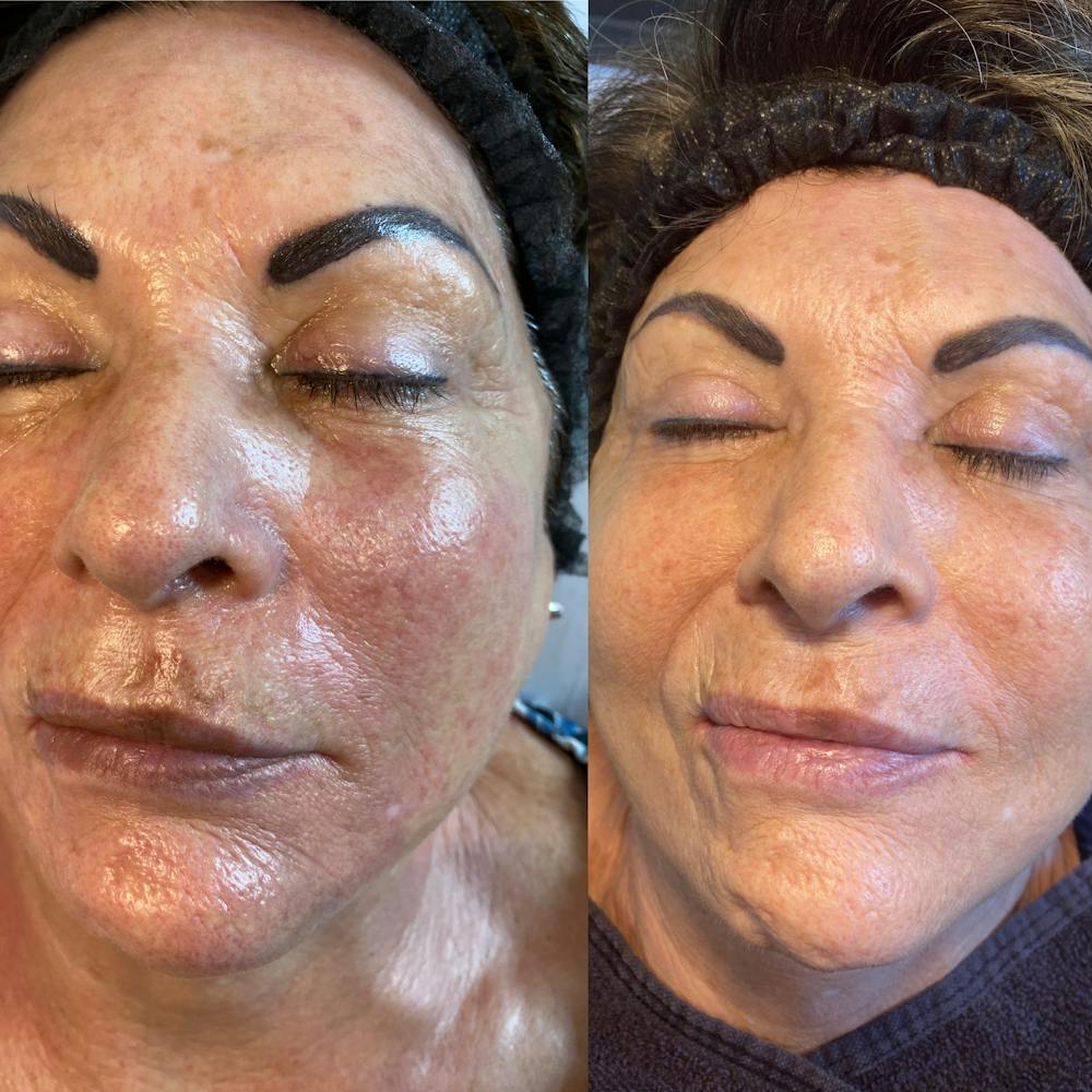 Microneedling Before & After Gallery - Patient 71703194 - Image 1