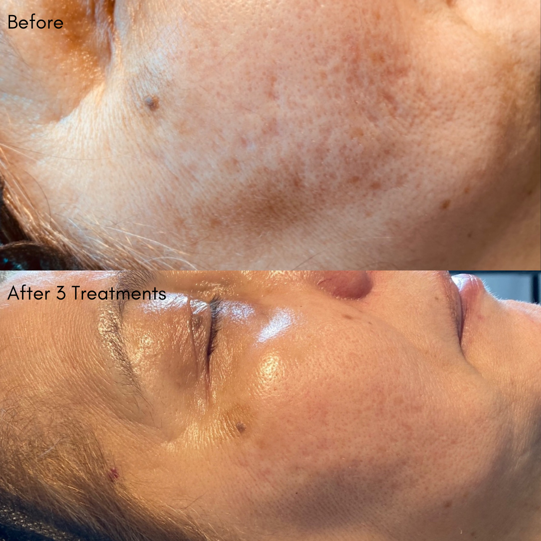 Chemical Peel