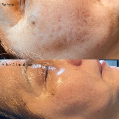 Chemical Peel Before & After Gallery - Patient 71703227 - Image 1