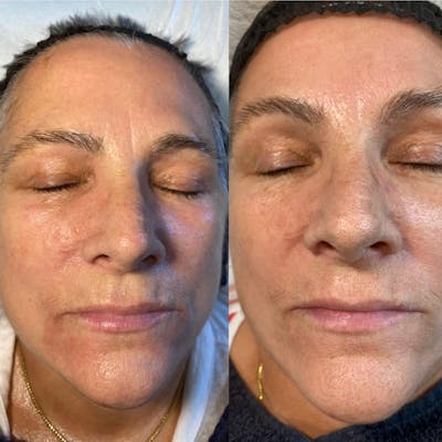 Microneedling Before & After Gallery - Patient 71703196 - Image 1