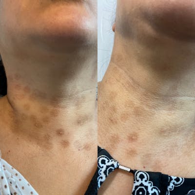 Chemical Peel Before & After Gallery - Patient 71703228 - Image 1