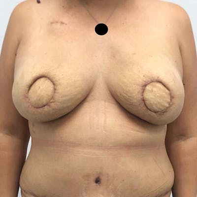 Breast Reconstruction Before & After Gallery - Patient 121819925 - Image 1