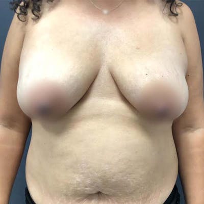 Breast Reconstruction Before & After Gallery - Patient 121819925 - Image 2