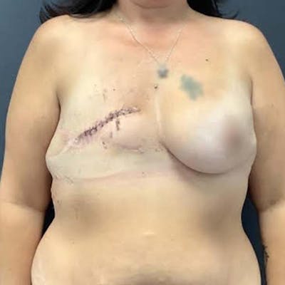 Breast Reconstruction Before & After Gallery - Patient 121819927 - Image 1