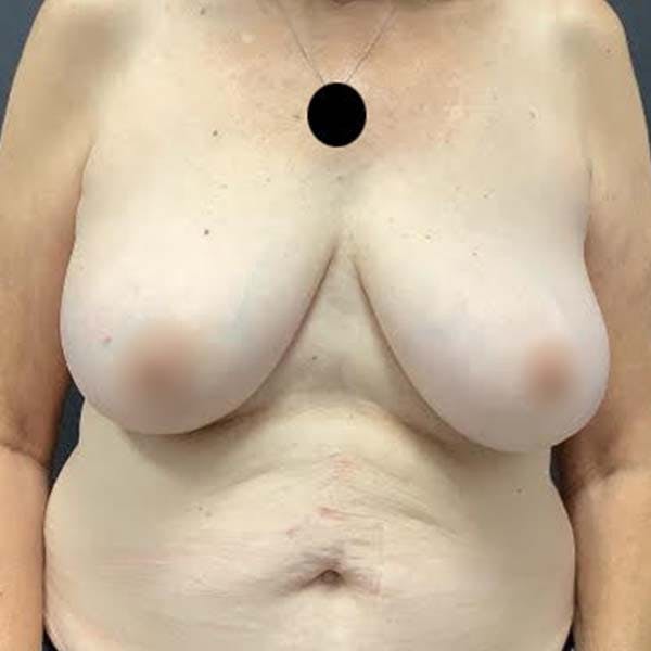 Breast Reconstruction Before & After Gallery - Patient 121819928 - Image 1