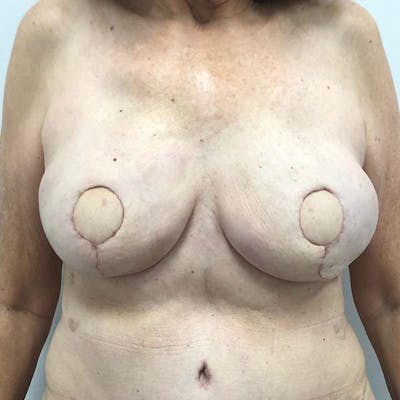 Breast Reconstruction Before & After Gallery - Patient 121819928 - Image 2