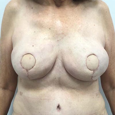 Breast Reconstruction Gallery - Patient 121819928 - Image 2