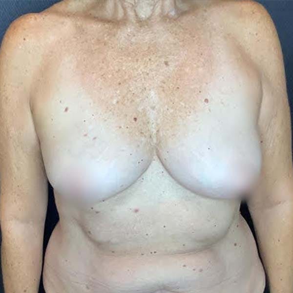 Breast Reconstruction Before & After Gallery - Patient 121819926 - Image 1