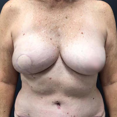 Breast Reconstruction Gallery - Patient 121819926 - Image 2
